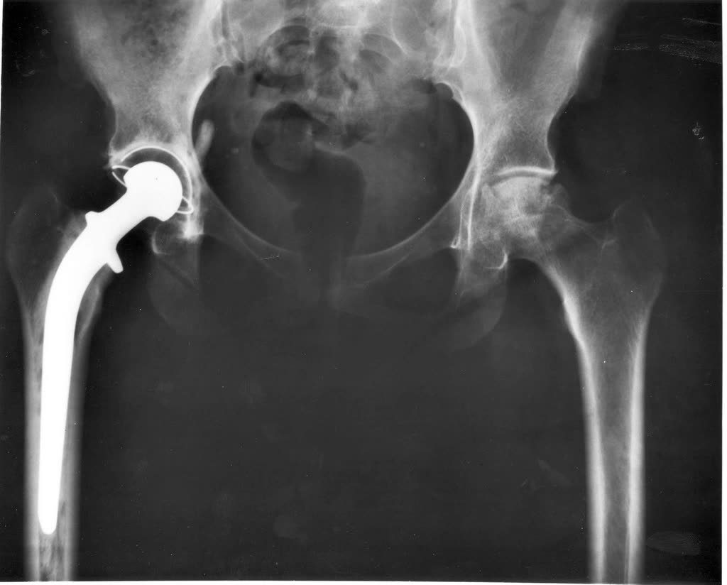 Pelvis X-ray showing a total hip replacement on one side