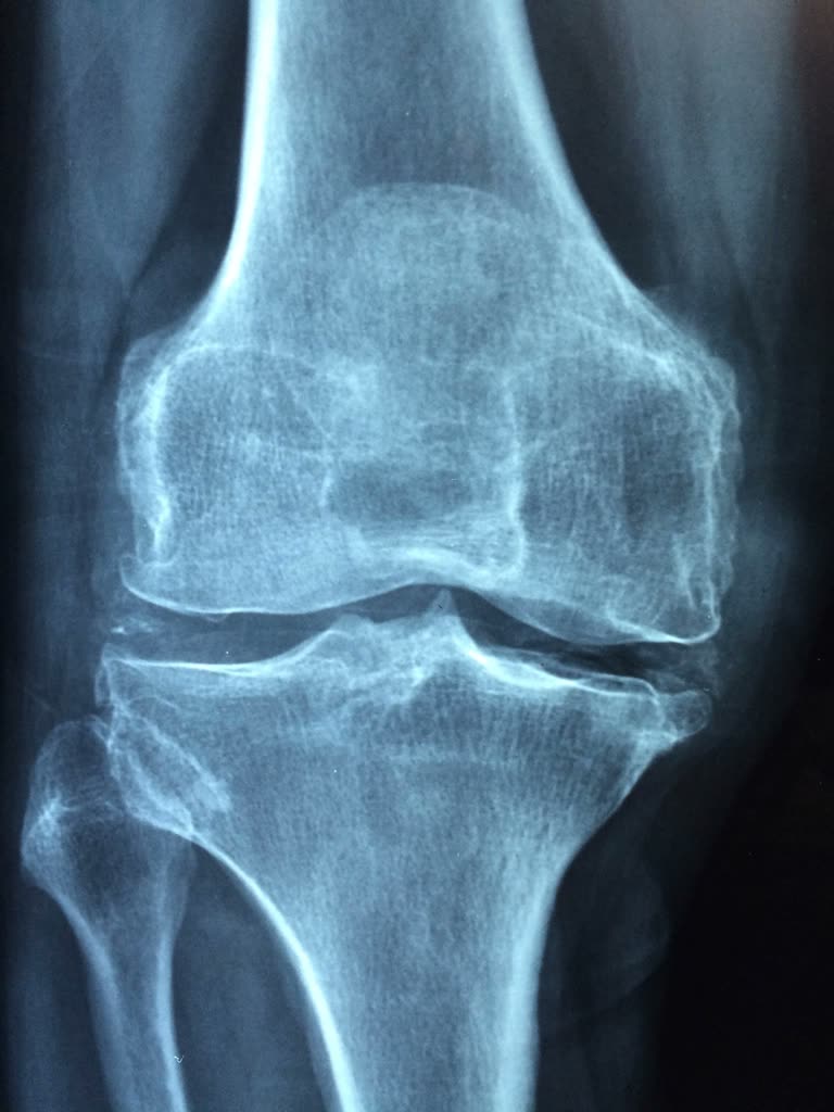 X-ray of a knee joint viewed from the front