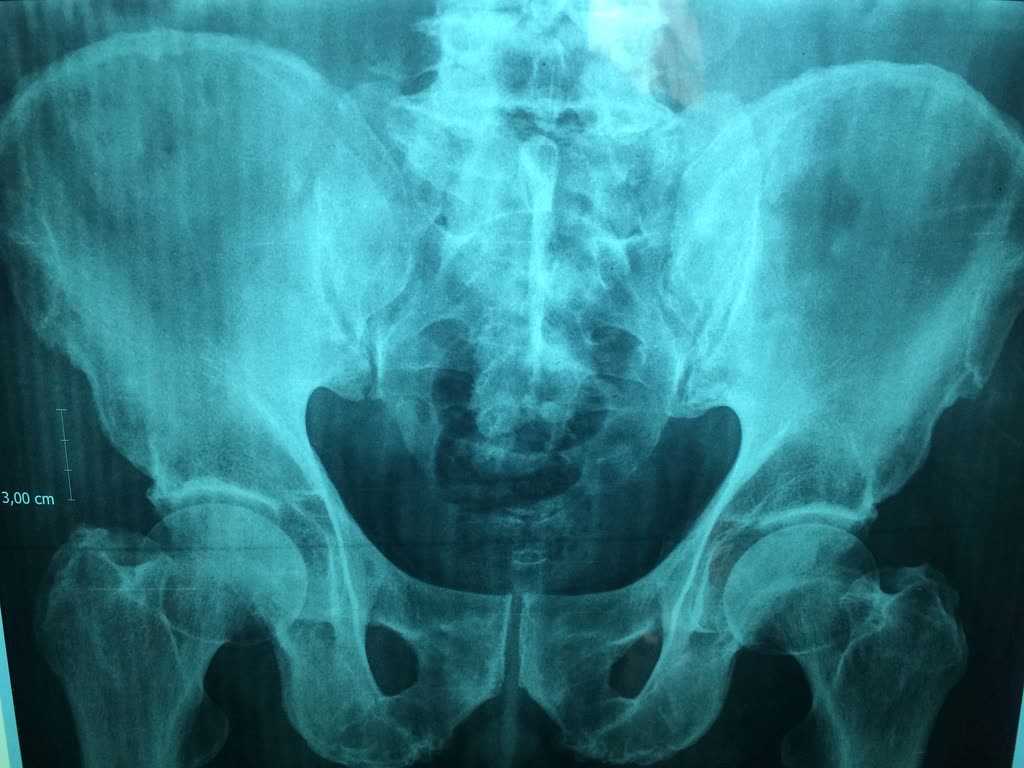 X-ray of the pelvis and both hip joints